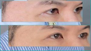Read more about the article Thermage ตา มีขั้นตอนการทำอย่างไร ปลอดภัยต่อดวงตาไหม
